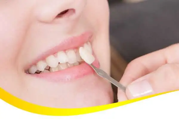 veneer gigi
