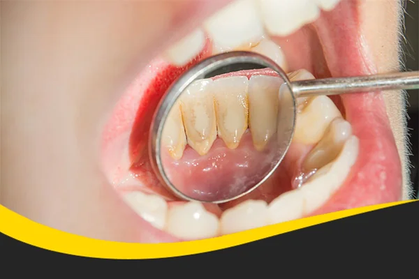 Harga Scaling termurah teman dental ciputat