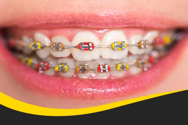 Harga Pasang behel Warna Klinik Gigi Teman Dental Paling Murah !