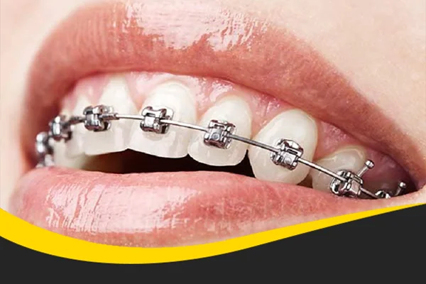 Perawatan Behel Klinik gigi teman dental