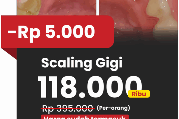 Promo scaling di website klinik gigi teman dental ada potongan 5rb